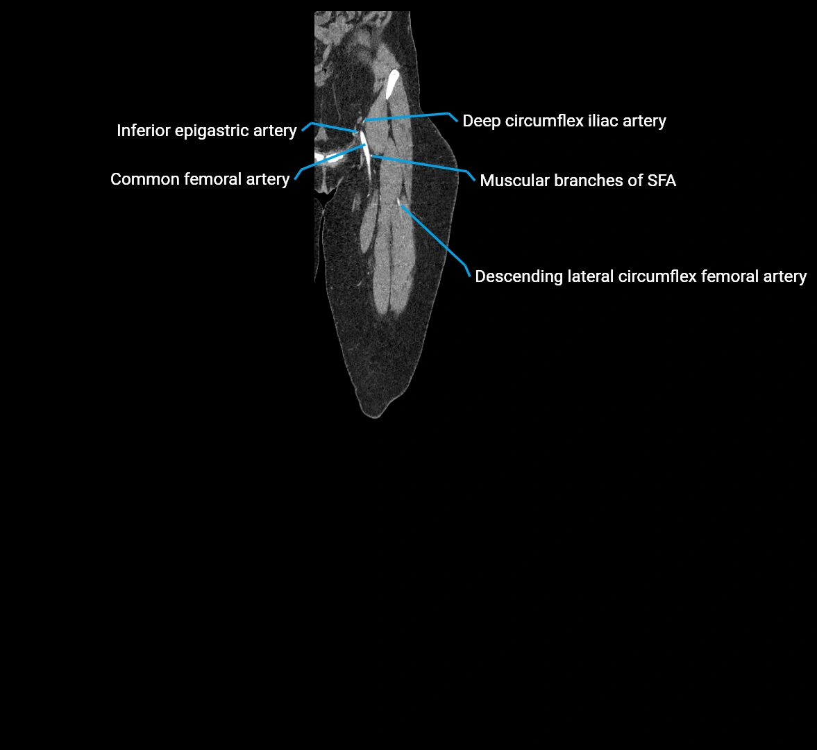 CTA lower limb coronal cross sectional anatomy labelled image _12 (1).webp